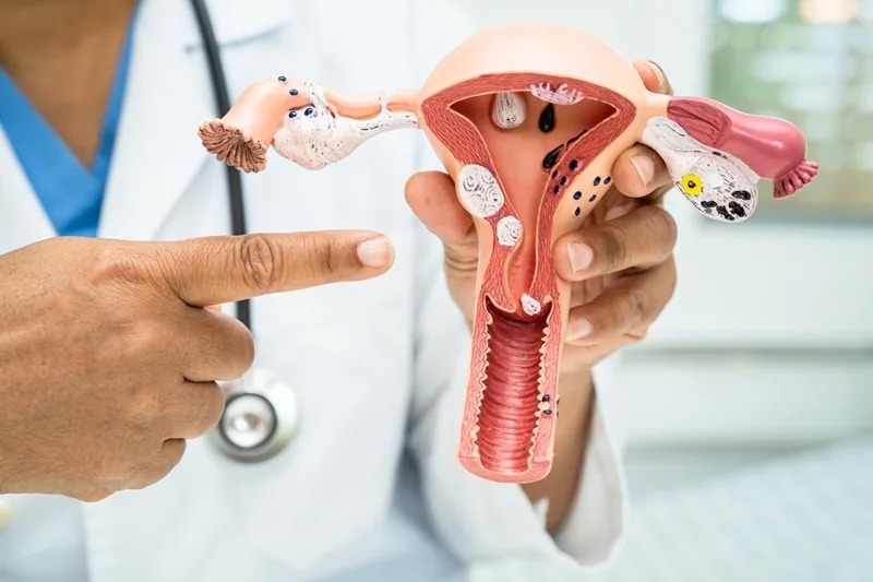 Cáncer de endometrio