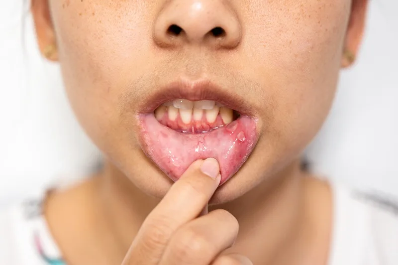 Lesiones por virus del papiloma humano